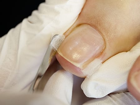 ネイルエキスパート科 本科 陥入爪・巻き爪ケア - 爪ケアも学べる全国