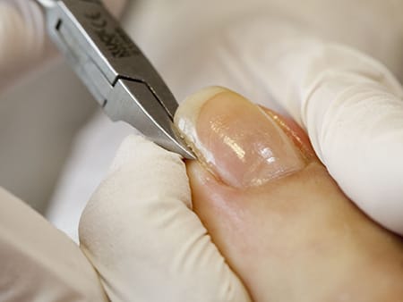 ネイルエキスパート科 本科 陥入爪・巻き爪ケア - 爪ケアも学べる全国